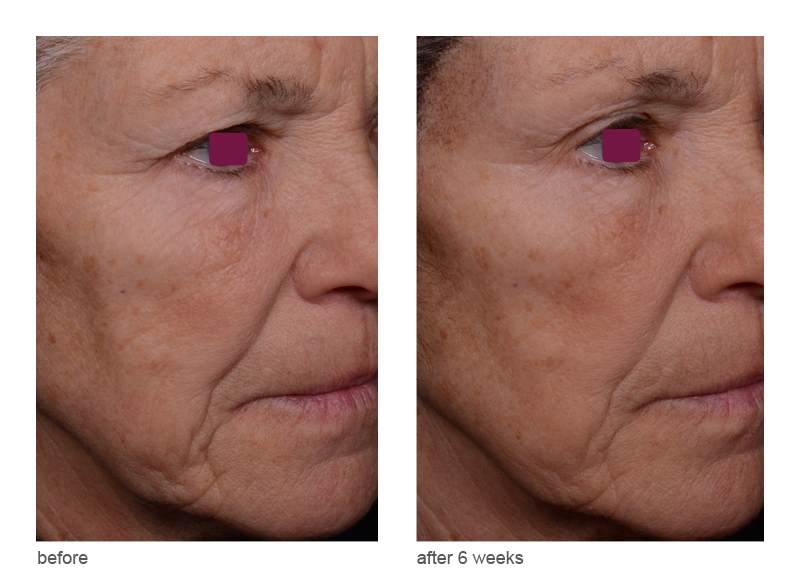visible wrinkle reduction with Matrixyl® Morphomics® by Sederma
