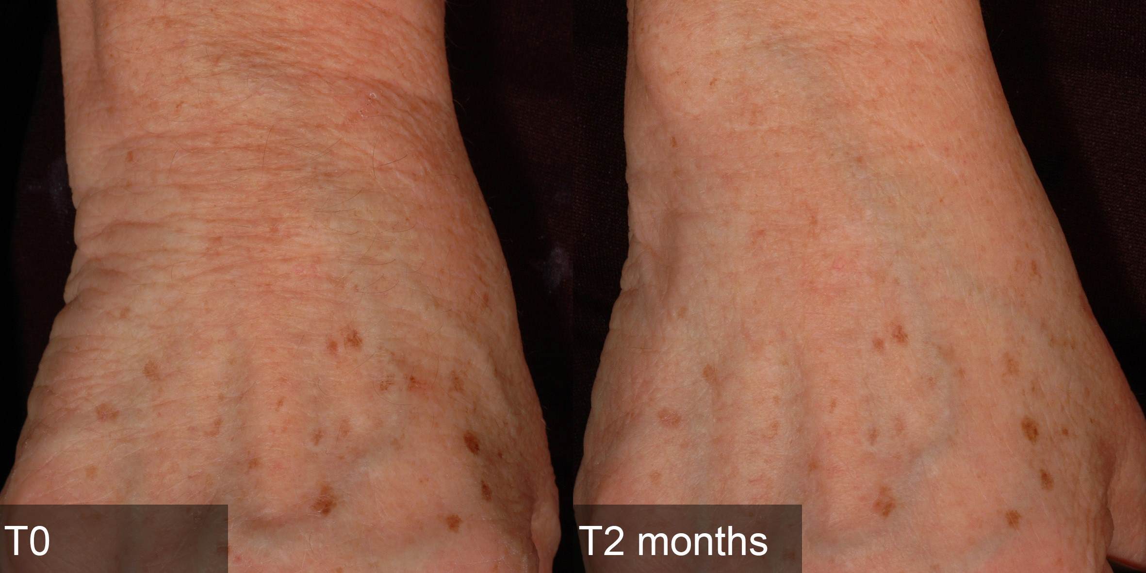 Comparison between T0 and T2 months after using Senestem